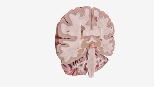Lesioni Cerebrali Sono Aree Del Tessuto Cerebrale Danneggiato — Video Stock