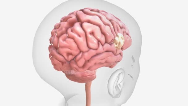 Tumor Cerebral Crescimento Células Cérebro Perto Dele — Vídeo de Stock