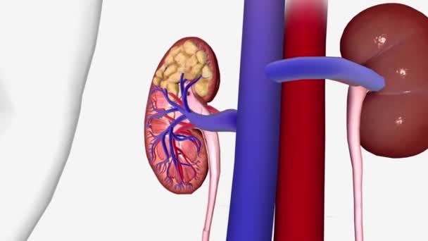 Stage Kidney Cancer Stage Tumor — Stock Video
