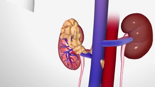 ステージIv腎臓癌 腎臓の周りに脂肪組織の層を超えて広がり癌と腎臓の上の副腎にまで広がるかもしれません — ストック動画