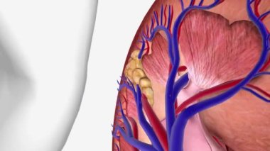 Birinci Aşama Böbrek Kanseri Birinci Aşama Tümör