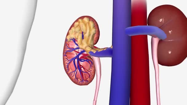 Kidney Cancer Stage Cancer Has Grown Surrounding Tissues Major Vein — Stock Video