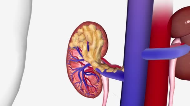 ステージIi腎臓癌腫瘍は7 Cmより大きく 腎臓にのみ位置しています — ストック動画