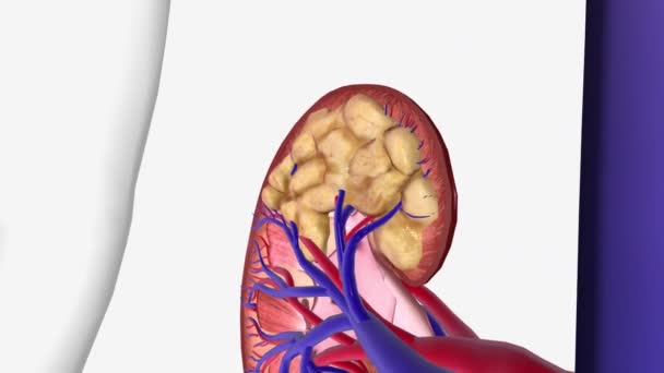 腎臓がんステージ3 癌は周囲の組織や近くの主要な静脈に成長しました — ストック動画