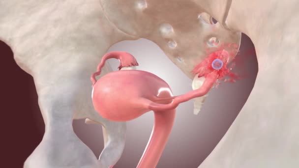 Embrio Kehamilan Ektopik Menyebabkan Pecah Tuba — Stok Video