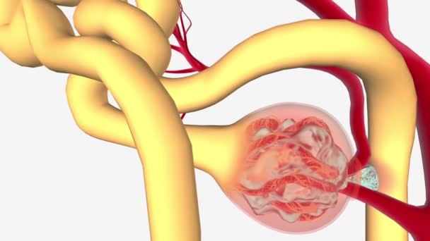 Nefropatia Por Iga Uma Forma Comum Glomerulonefrite Causada Pela Deposição — Vídeo de Stock