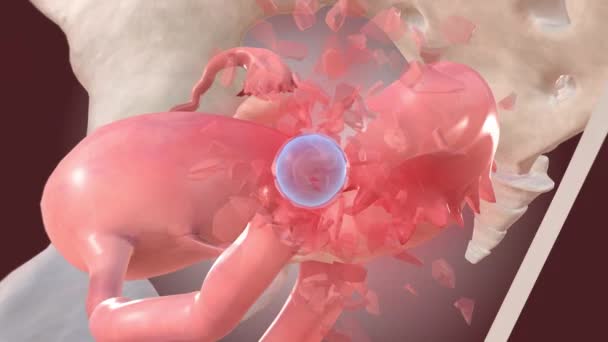 Ektopischer Schwangerschaftsembryo Verursacht Rohrbruch — Stockvideo