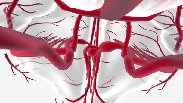 Cerebral Aneurysm Weak Thin Spot Artery Brain Balloons Bulges Out — Stock Video
