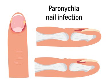Paronychia concepnt vector for medical blog, app, banner. Nail inflammation that may result from trauma, irritation or infection. It can affect fingernails or toenails. clipart