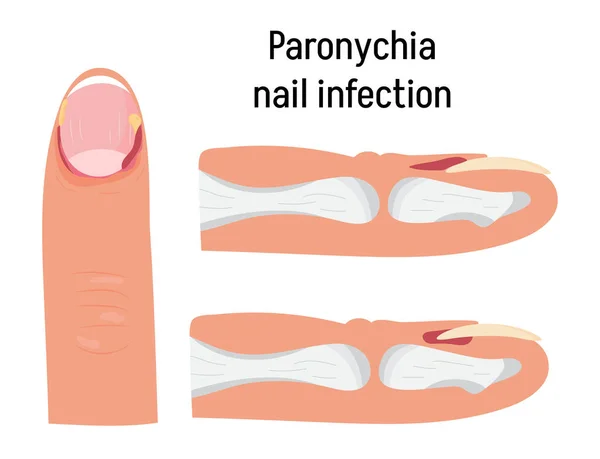 Paronychia Concepnt Vecteur Pour Blog Médical App Bannière Inflammation Des — Image vectorielle