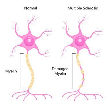 Nöron konsept vektörü. Dendrite, akson, nöron soması. Çoklu skleroz, sinir anatomisi çizimi. Beyin hücresinin miyelin ve çekirdeği.