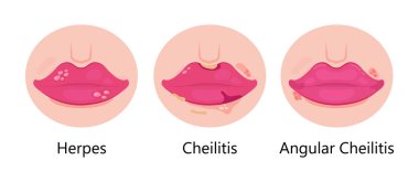 Uçuk dudak vektörü. Simplex virüs enfeksiyonu cilt, ağız ve dudaklarda tekrarlanan küçük, acılı, sıvı dolu kabarcıklara neden olur. Cheilitis gösterilir.