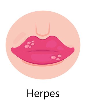 Uçuk dudak vektörü. Simplex virüs enfeksiyonu cilt, ağız ve dudaklarda tekrarlanan küçük, acılı, sıvı dolu kabarcıklara neden olur. Cheilitis gösterilir.