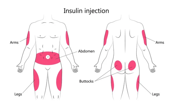Infografischer Insulininjektionsvektor Diabetes Behandlung Und Insulinspritzen Bereich Auf Den Menschlichen — Stockvektor