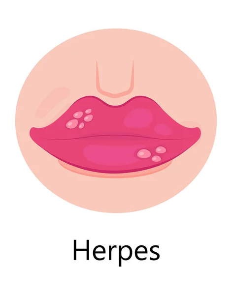 Herpes Lips Vector Simplex Virus Infection Causes Recurring Episodes Small — Stock Vector