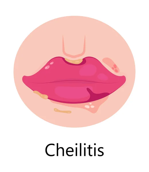 唇のベクトルをヘリプス 単純なウイルス感染症は 唇に小さな 痛みを伴う 流体で満たされた水疱の繰り返しのエピソードを引き起こします 肝炎が示されています — ストックベクタ