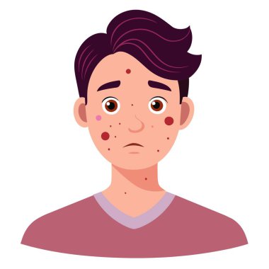 Genç adamın yüzünde sivilce var, saç çizgisi, burnu, yanakları, çenesi ve çenesi de dahil. Kaşları ve boynu da sivilce belirtileri gösteriyor.