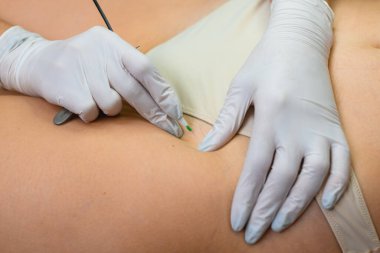 Electrolysis professional hair removal in bikini zone, cosmetologist hands in gloves work on female skin close up