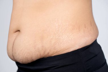 Çocuk sahibi olduktan sonra göbekli ve karın çizgili Womon. Cilt ve vücut bakımı kavramı.