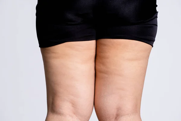 セルライト付きの女性の足 スキンケアとボディケアのコンセプト — ストック写真