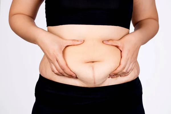 白い背景に太った女の腹部の表面と腹部の縞 肌とボディケア 脂肪の女の子 脂肪の腹 ぽっちゃり — ストック写真