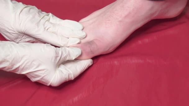 Hands Doctor Medical Gloves Examine Bruised Toe Man — Stock Video