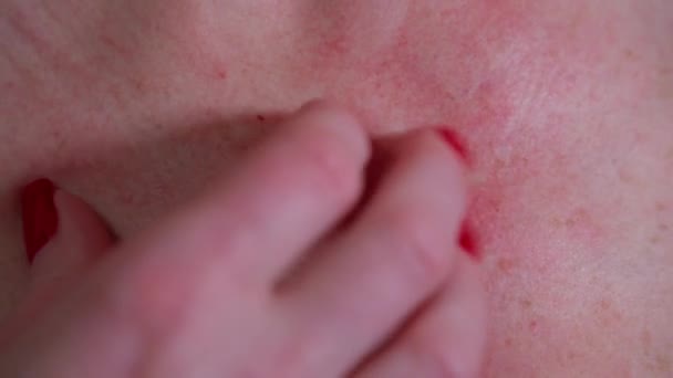 Mano Mujer Rasguña Piel Roja Irritada Con Erupción Alérgica — Vídeo de stock