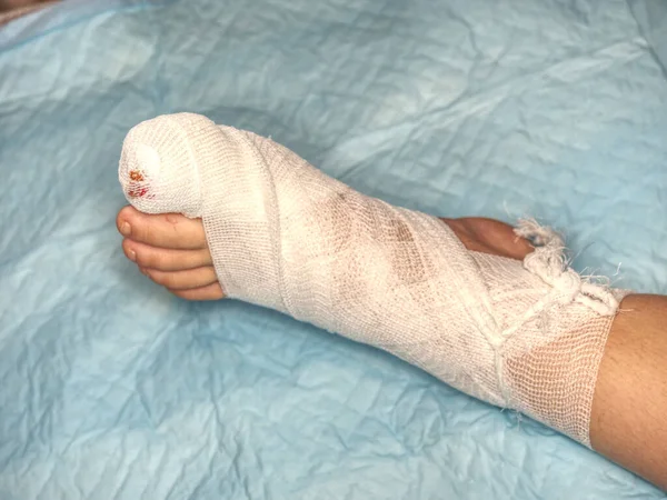 Bloody toe and hurt leg. Wounded children leg with bandaged ankle and foot after accident.