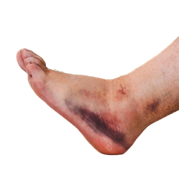 白い背景に隔離された人の足首の傷害 — ストック写真