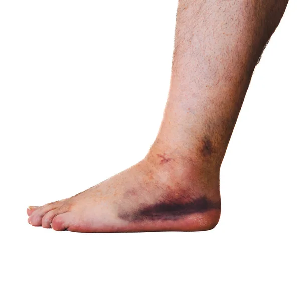 白い背景に隔離された人の足首の傷害 — ストック写真