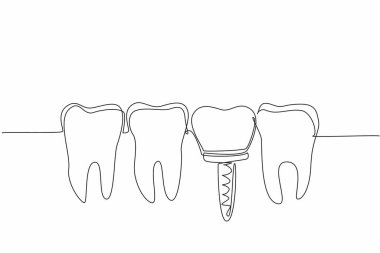 Devamlı bir diş çizme hattı hizalanır ve bunlardan biri de implant dişidir. Çürükleri önlemek için her şeyi yapın. Daha şefkatli. Dünya Ağız Sağlığı Günü. Tek çizgi çizimi tasarım vektör çizimi