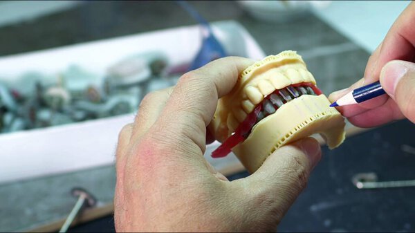 Исследования циркония фарфора и имплантата в лаборатории зубов 