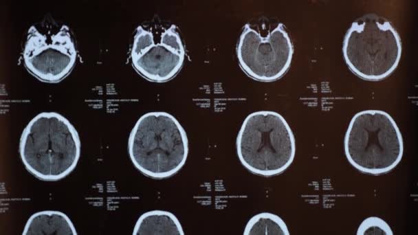 Magnetische Resonantie Beeldvorming Van Hersenen Een Traumatisch Hersenletsel Bij Een — Stockvideo