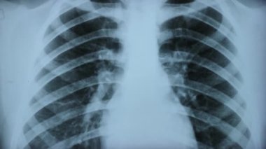 X-RAY ASSESSMENT OF THE LUNGS NORM AND PATHOLOGY. In the image of the chest of lung abnormalities, areas of high or low density are manifested. Close up
