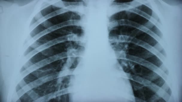 Ray Aressment Lungs Norm Pathologyy Зображенні Аномалій Грудної Клітки Виявляються — стокове відео