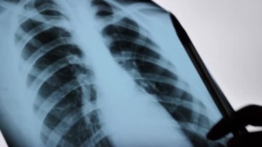 NORMAL AND PATHOLOGICAL LUNG X-RAY. X-RAY scan of the chest of the lungs reveals abnormalities, areas of increased or low density, diagnosis of pneumonia, coronavirus Close up