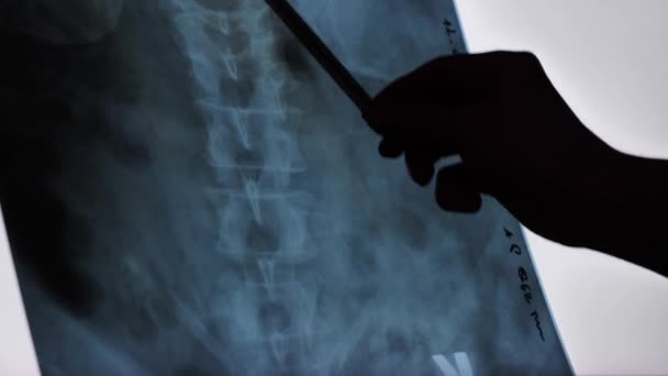 レンゲン X線脊椎のクローズアップ 老人の脊髄 病院の神経科医による検査 — ストック動画