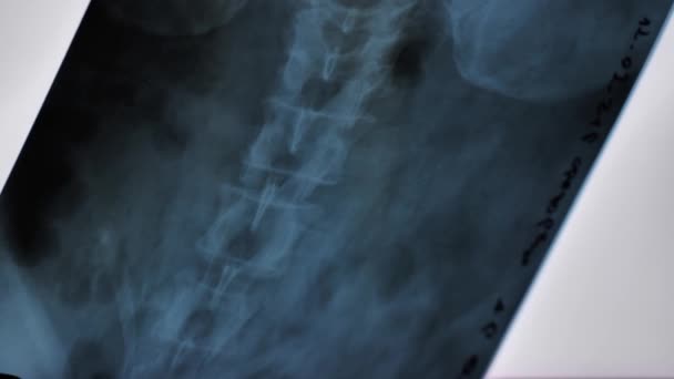 Rengen Rey Close Spine Spinal Cord Old Elderly Man Examination — 图库视频影像