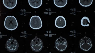 Magnetic resonance imaging, MRI of human brain after traumatic head injury, stroke, illness in elderly man in hospital. Examination by a neurologist