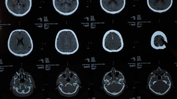 Магнітно Резонансна Томографія Мрт Мозку Людини Після Травми Голови Інсульту — стокове відео