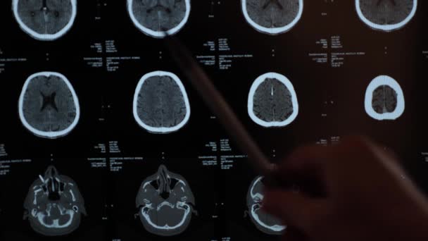 異なる側面からの脳の磁気共鳴画像 病院の60歳の男性患者の外傷性脳損傷は 脳が影響を受けていることを示しています 神経科医による検査 — ストック動画
