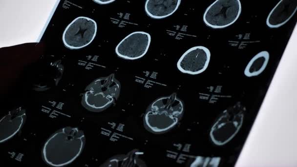Magnetic Resonance Imaging Brain Traumatic Brain Injury Elderly Male Patient — 图库视频影像