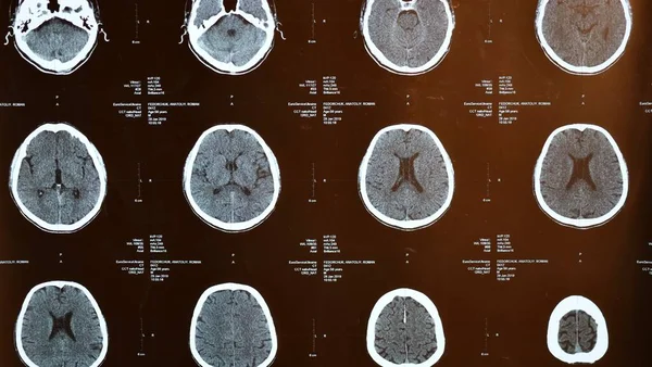 Magnetic resonance imaging, MRI of human brain after traumatic head injury, stroke, illness in elderly man in hospital. Examination by a neurologist