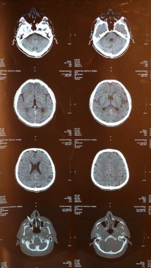 Hastanedeki yaşlı bir erkek hastada travmatik beyin hasarı sonucu oluşan manyetik rezonans görüntülemesi beynin etkilendiğini gösteriyor.