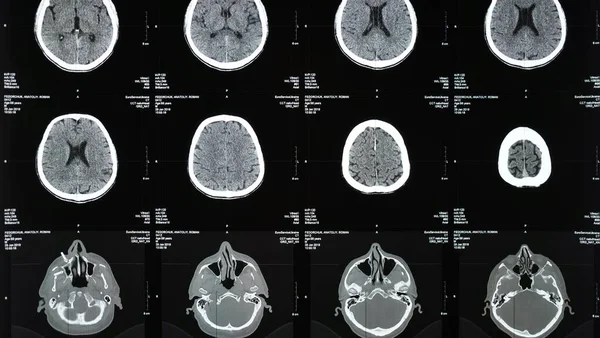Magnetic Resonance Imaging Brain Different Sides Traumatic Brain Injury Old Imagen de archivo