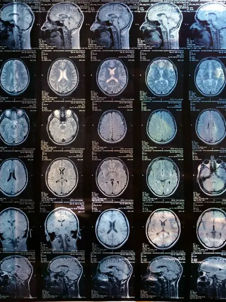 İlk aşamada çoklu skleroz geçiren bir hastanın insan beyninin MR 'ı. X-ışını dikey görüntüsü