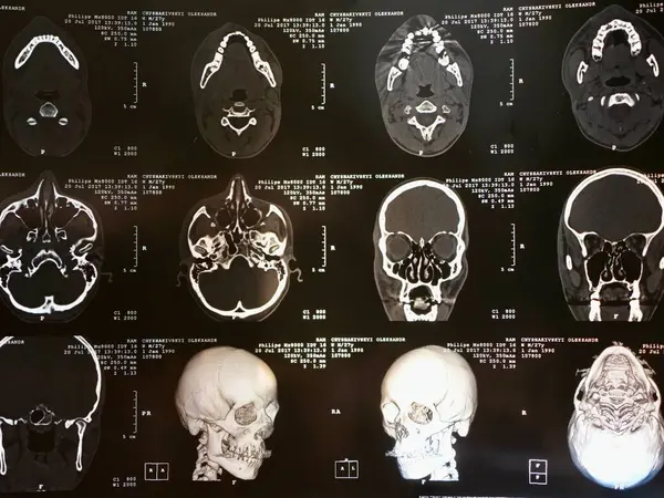 İlk aşamada çoklu skleroz geçiren bir hastanın insan beyninin MR 'ı. X-ışını dikey görüntüsü