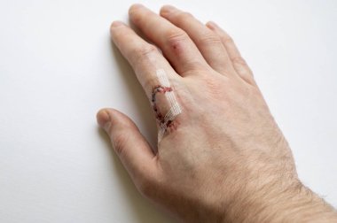 Kesişme noktası olan yaralı bir parmağın detaylı görüntüsü, beyaz arka planda kan sızıntısı var.