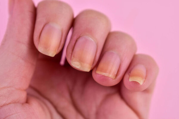 Damaged nails of a woman after. Overgrown nail cuticle and damaged and yellowed nail plate. Blurred.