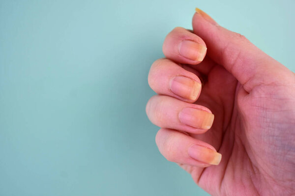 Damaged and yellowed nails of a woman on a blue background.Copy space.